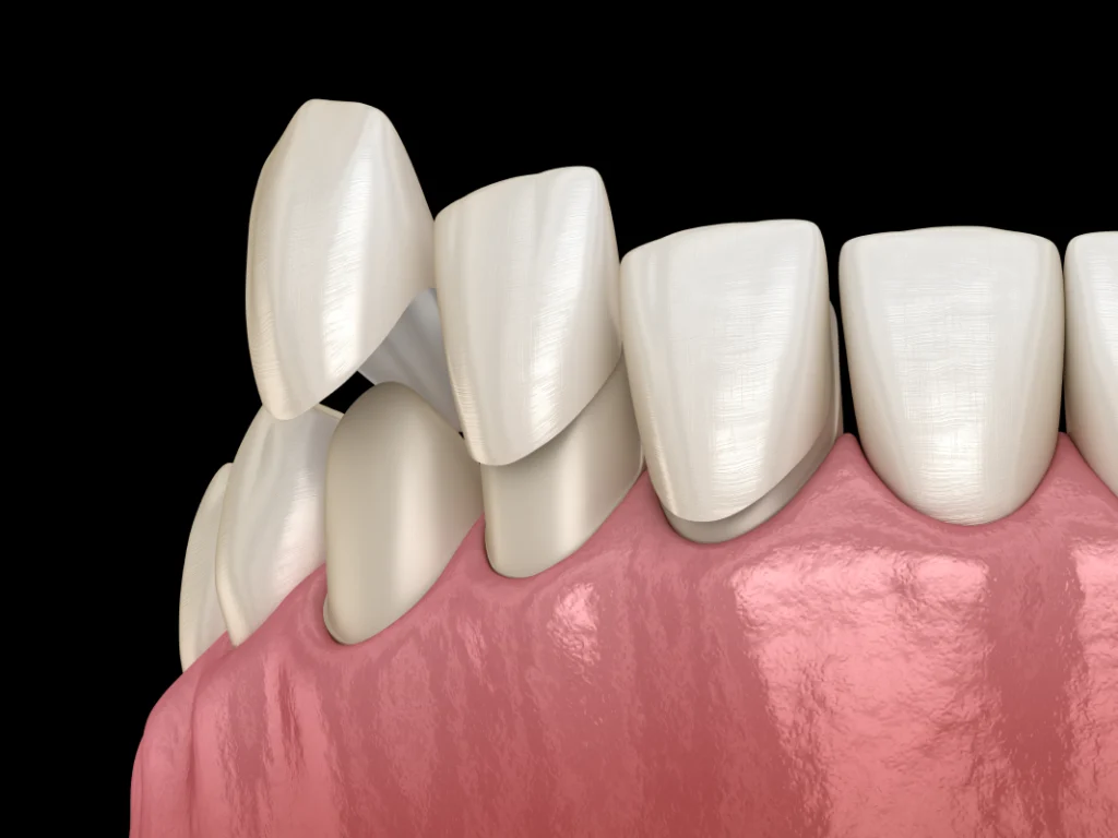 facettes dentaires veneers Soins dentaires esthétiques Dentistes et ophtalmologue à Saint-Ouen-sur-Seine