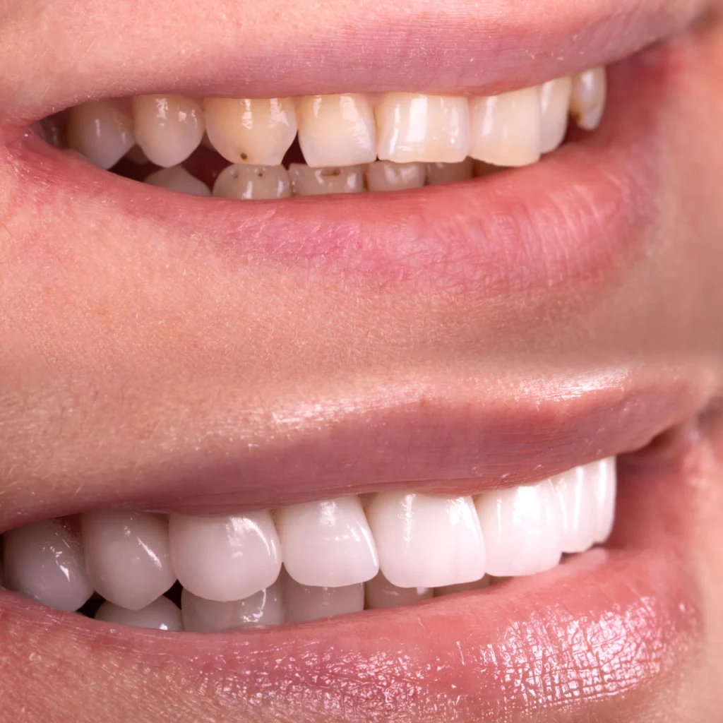 facettes dentaires veneers cas clinique paris Facettes dentaires Dentistes et ophtalmologue à Saint-Ouen-sur-Seine