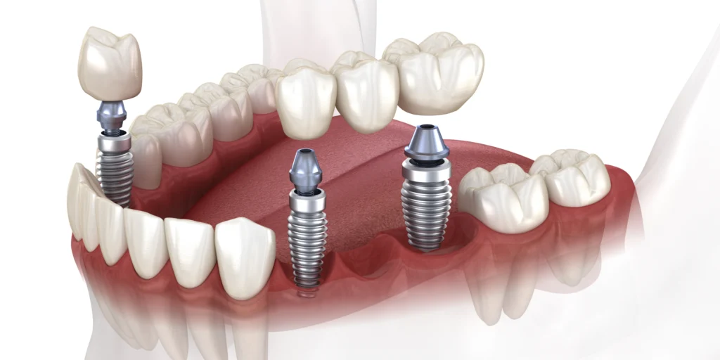 implant dentaire bridge Implants dentaires Dr Johan Cinçon - Chirurgien-dentiste à La Teste-de-Buch