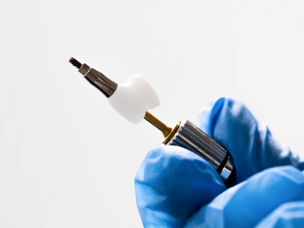 implant dentaire dent manquante Omnipratique Dentistes et ophtalmologue à Saint-Ouen-sur-Seine